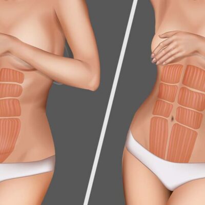 Diastase Abdominal: O que é e como tratar?