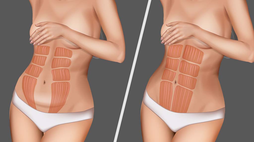 Diastase Abdominal: O que é e como tratar?