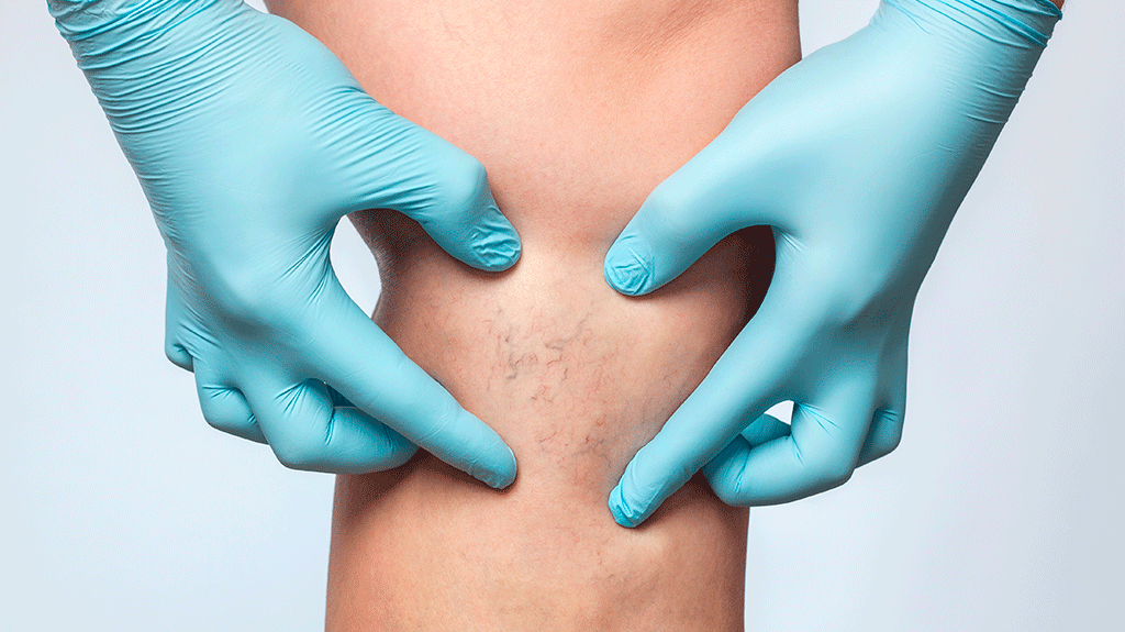 Angiologia e Cirurgia vascular – o que é?