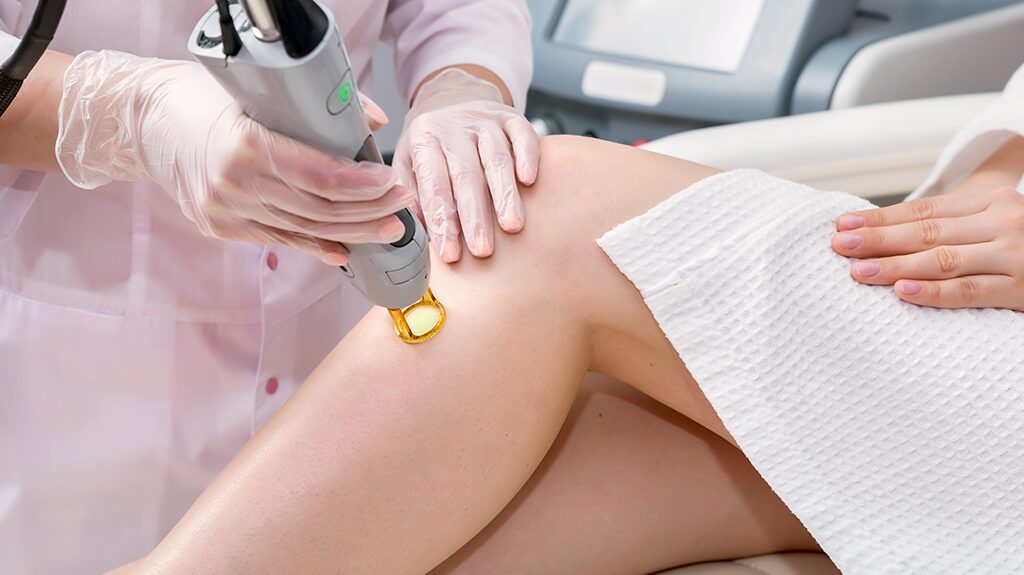 Tratamento de varizes a Laser