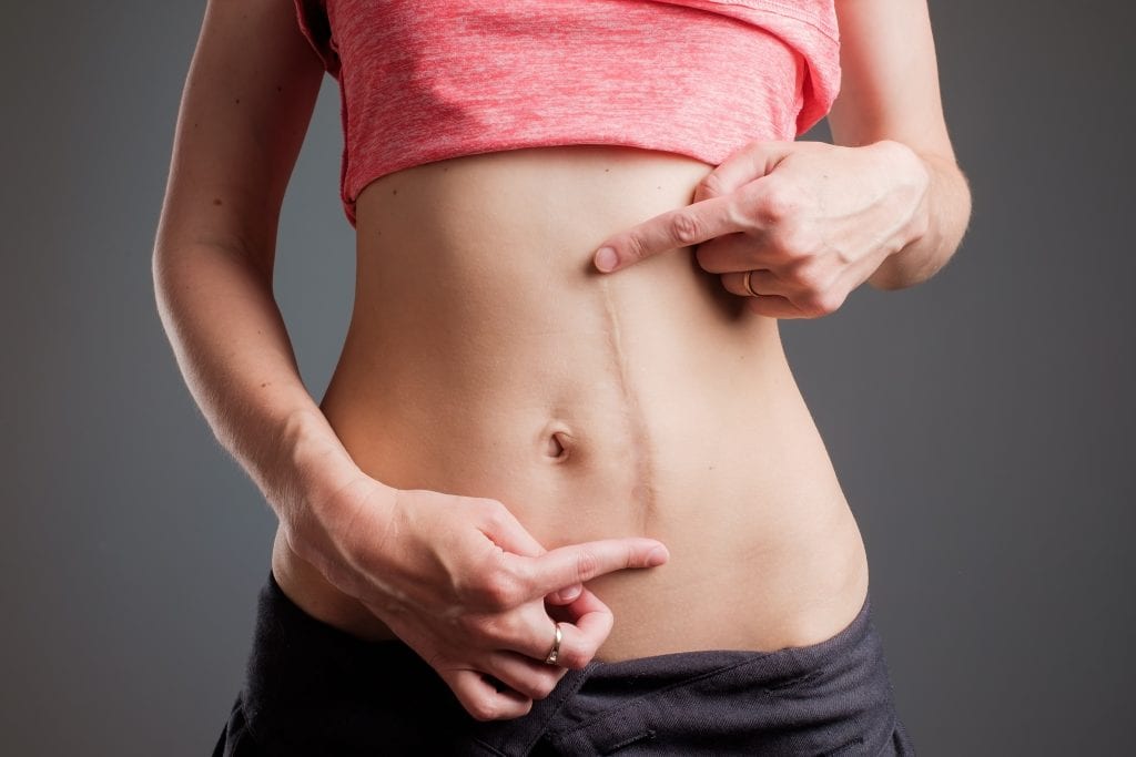 Cirurgia para correção de cicatriz