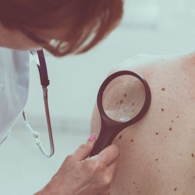 Cirurgia para retirada de tumores cutâneos