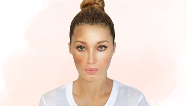 Melasma: o que é e como tratar