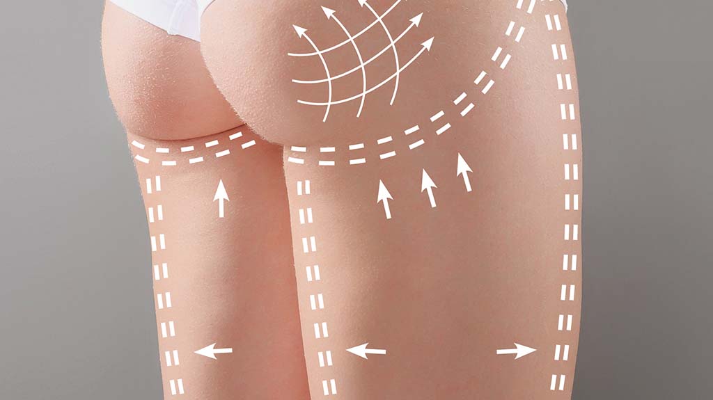 Body Lifting: tudo o que você precisa saber antes de realizar!