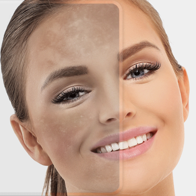 Tratamentos indicados para melasma