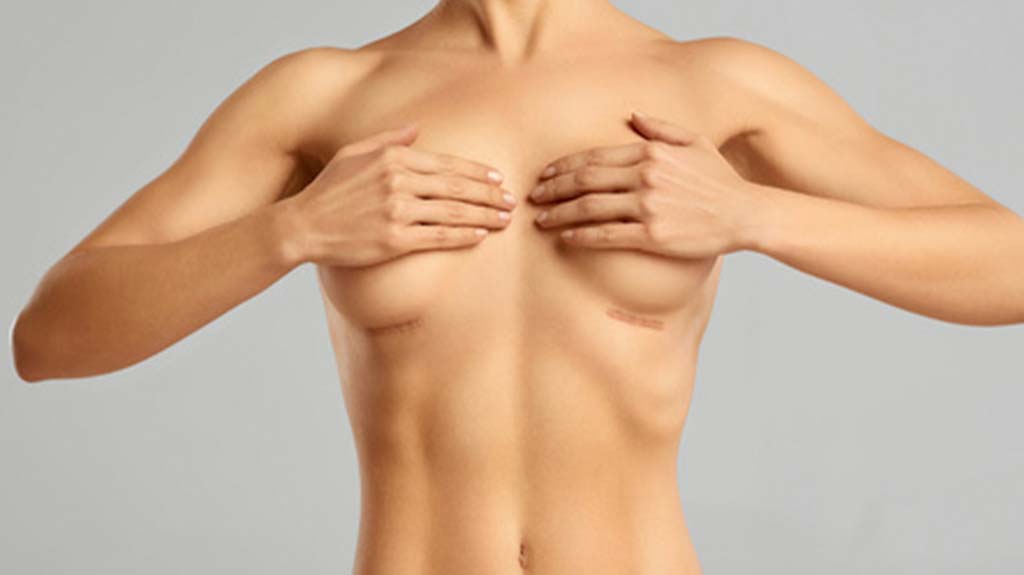 Como cuidar da cicatriz da mamoplastia?